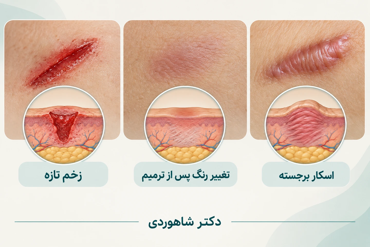 مقایسه زخم تازه، تغییر رنگ پس از ترمیم و اسکار برجسته در سه طرح پوست