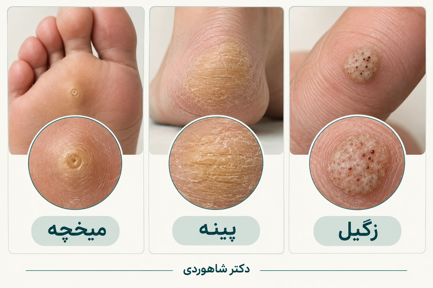 مقایسه میخچه، پینه و زگیل