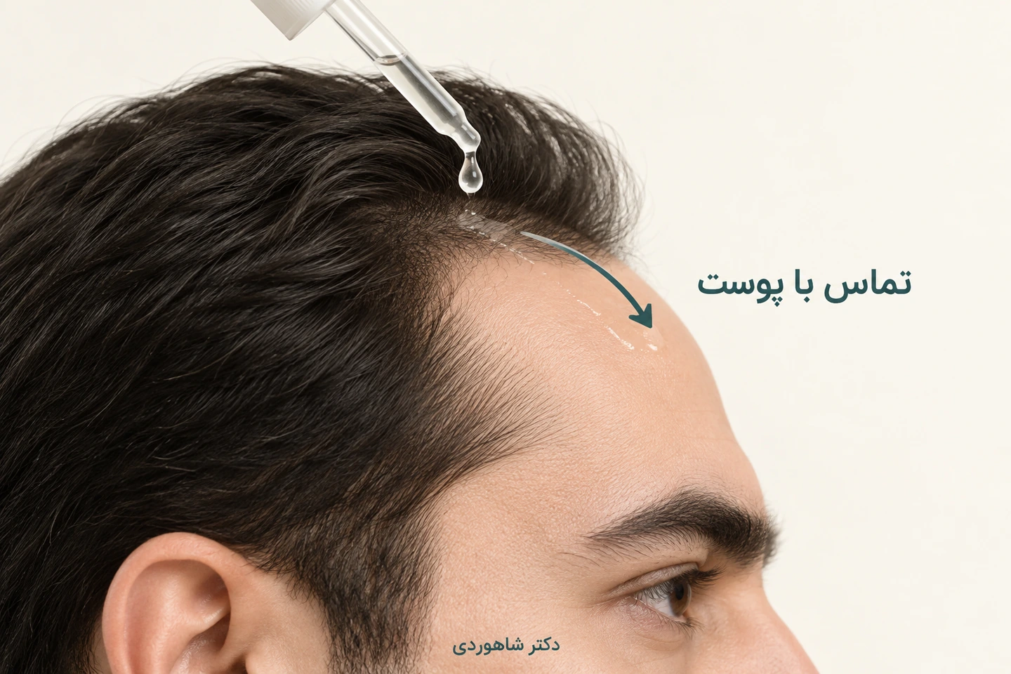 ارتباط تماس محصول مو با پوست کنار پیشانی