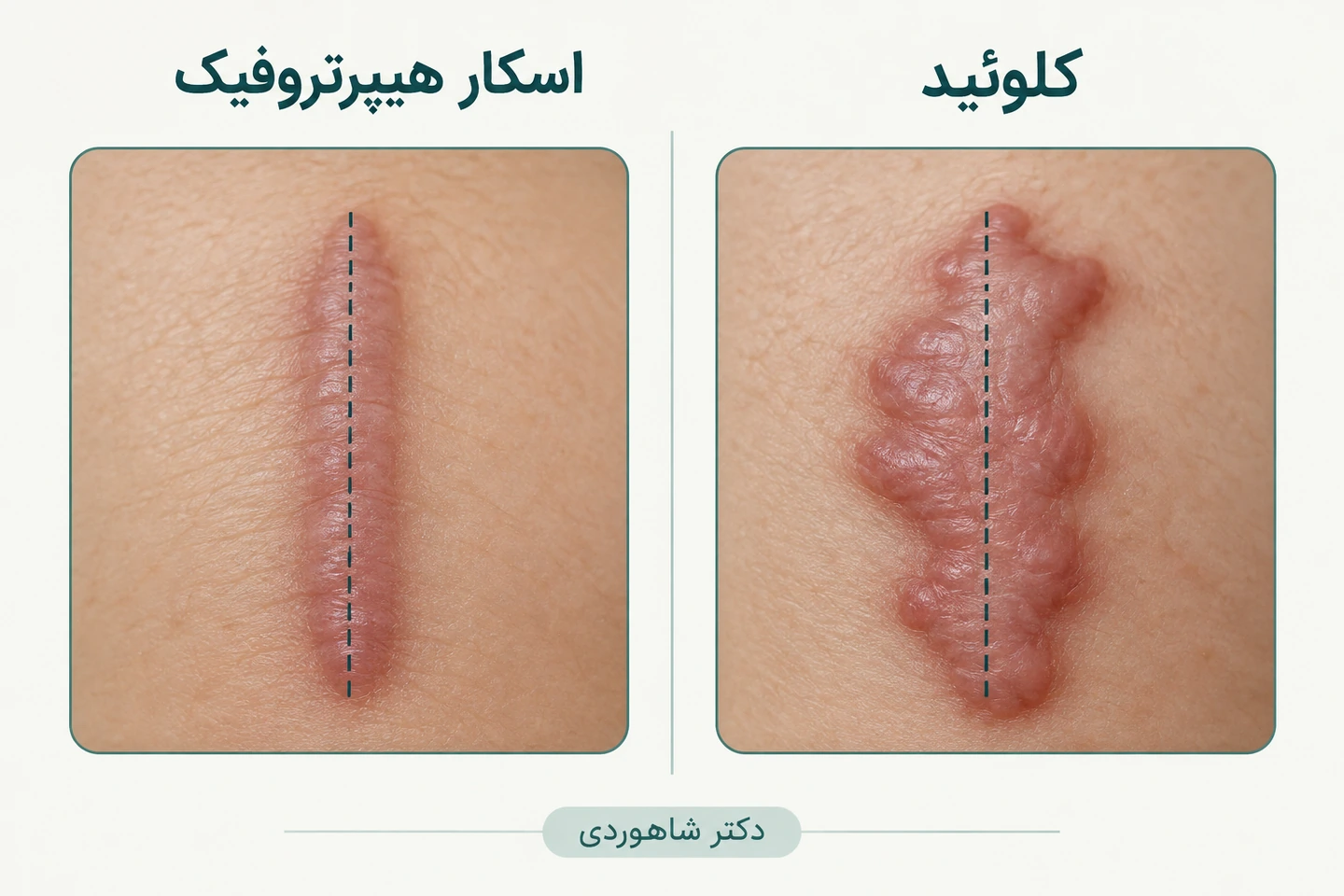 تفاوت اسکار برجسته محدود و کلوئید
