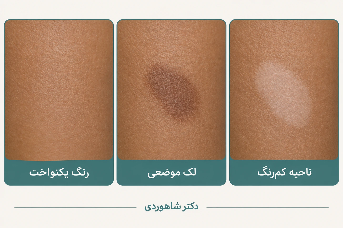 سه قاب پوست با رنگ یکنواخت، لک موضعی و ناحیه کم‌رنگ