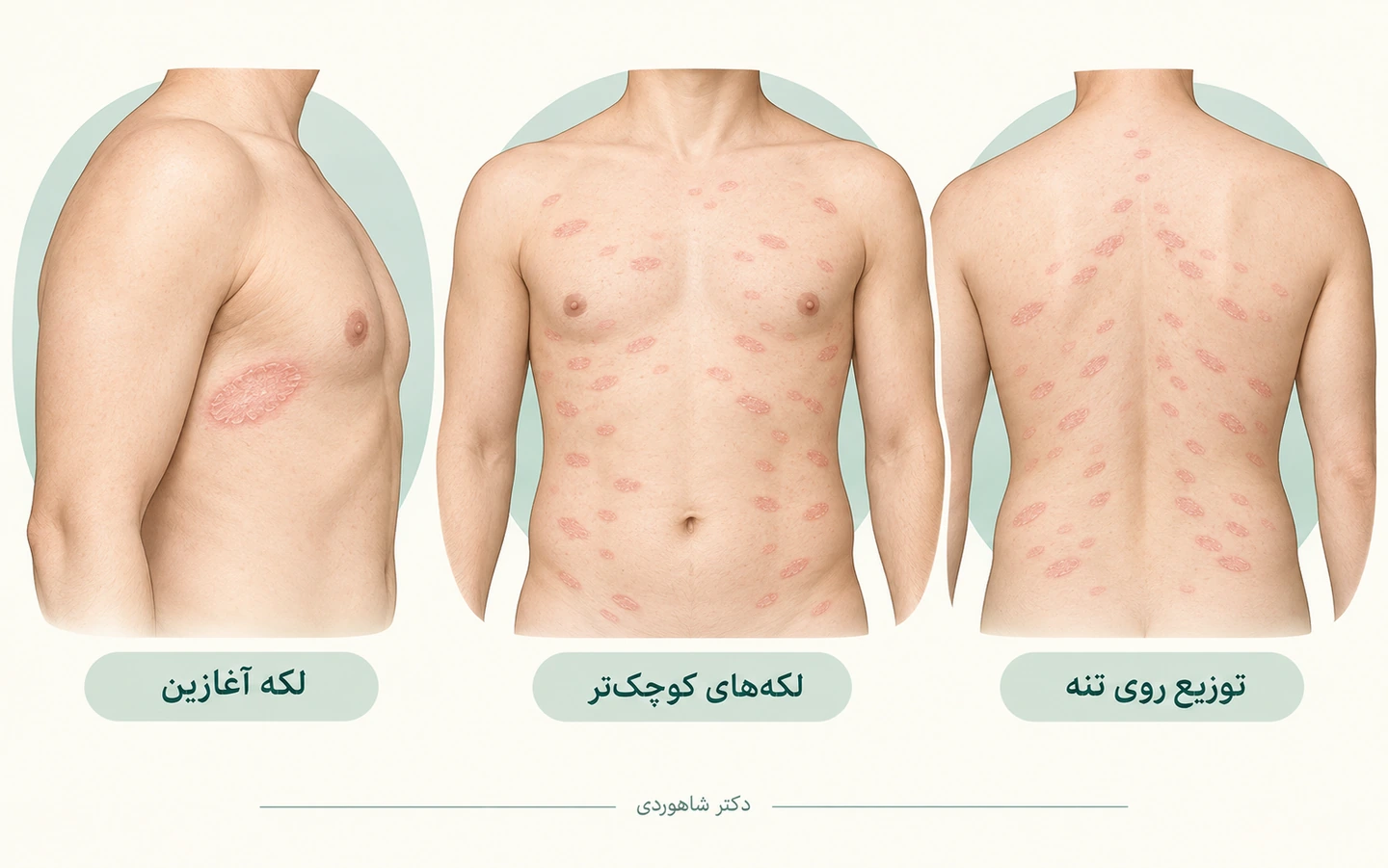 الگوی لکه مادر و لکههای کوچکتر پیتیریازیس روزهآ روی تنه