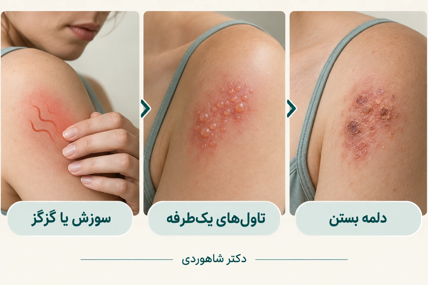 سوزش یا گزگز، تاول و دلمه در روند زونا
