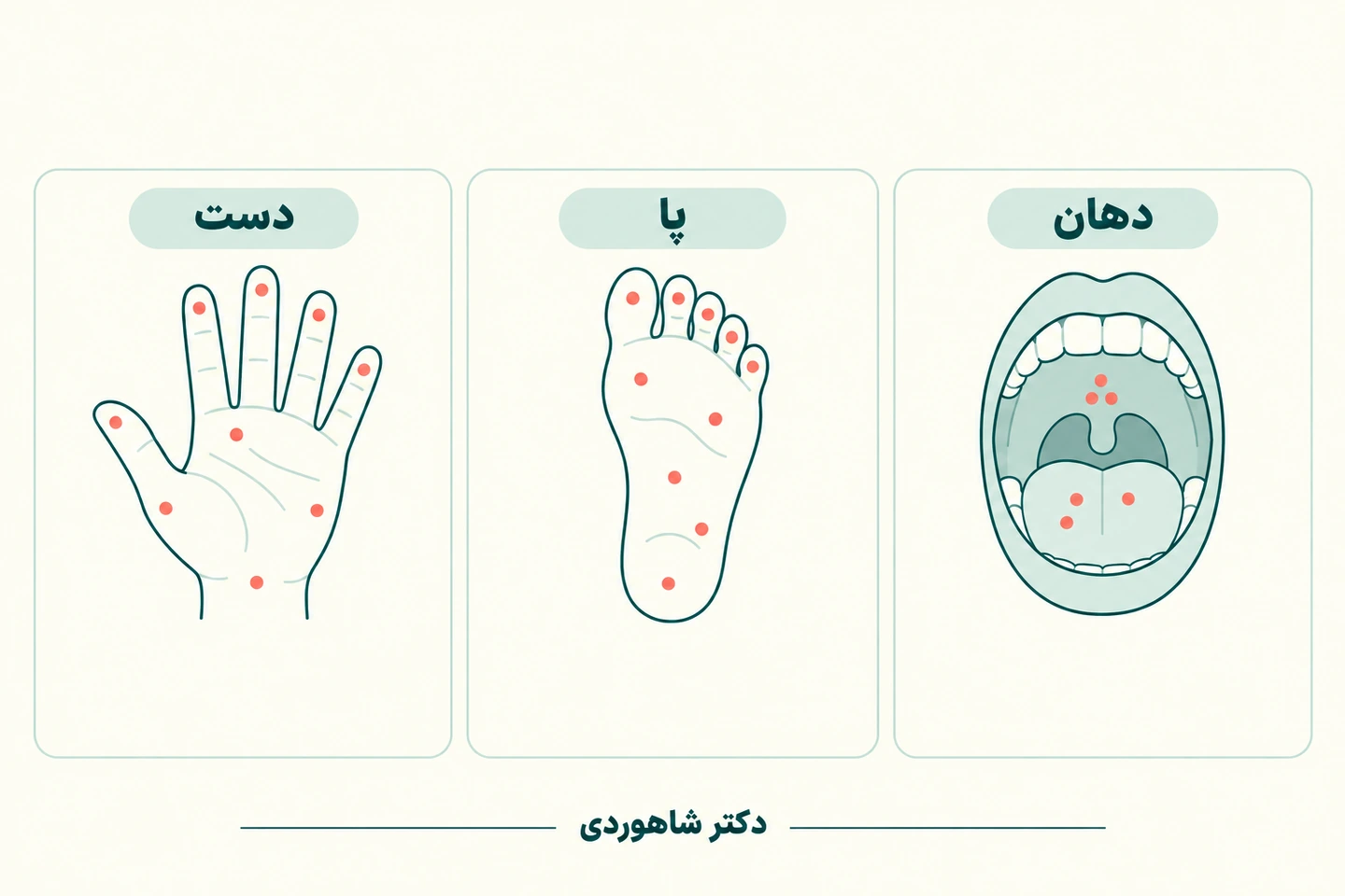 نقشه محل ضایعات روی کف دست، کف پا و داخل دهان