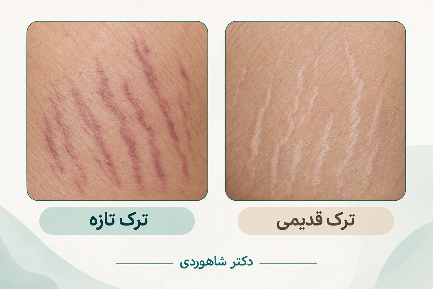 مقایسه ترک‌های تازه و قدیمی پوست
