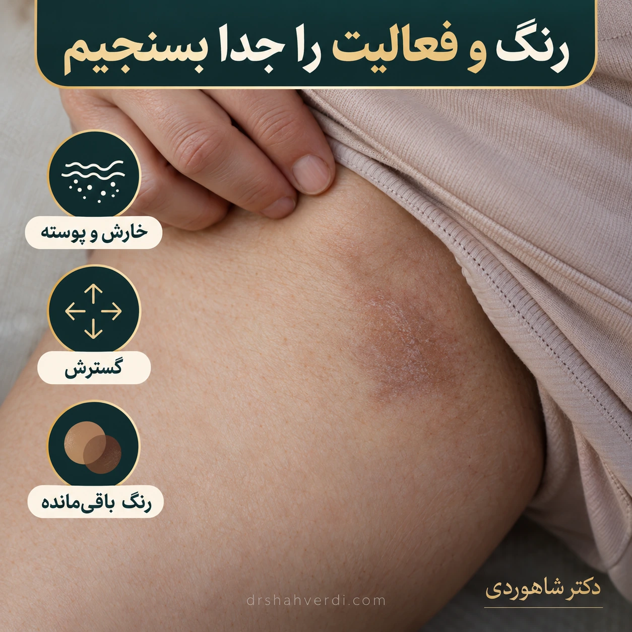 لکه قهوه‌ای پوست کنار عنوان‌های خارش و پوسته، گسترش و رنگ باقی‌مانده