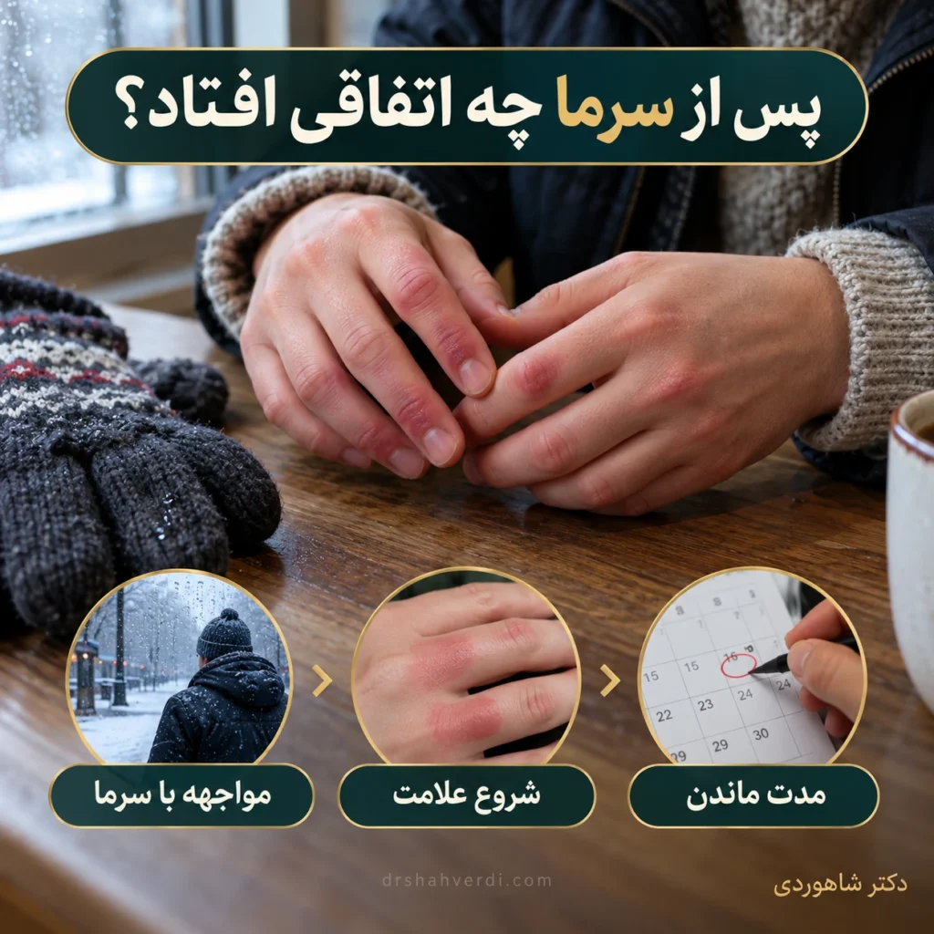 تصویر مقاله پرنیو؛ قرمزی و خارش انگشتان پس از سرما