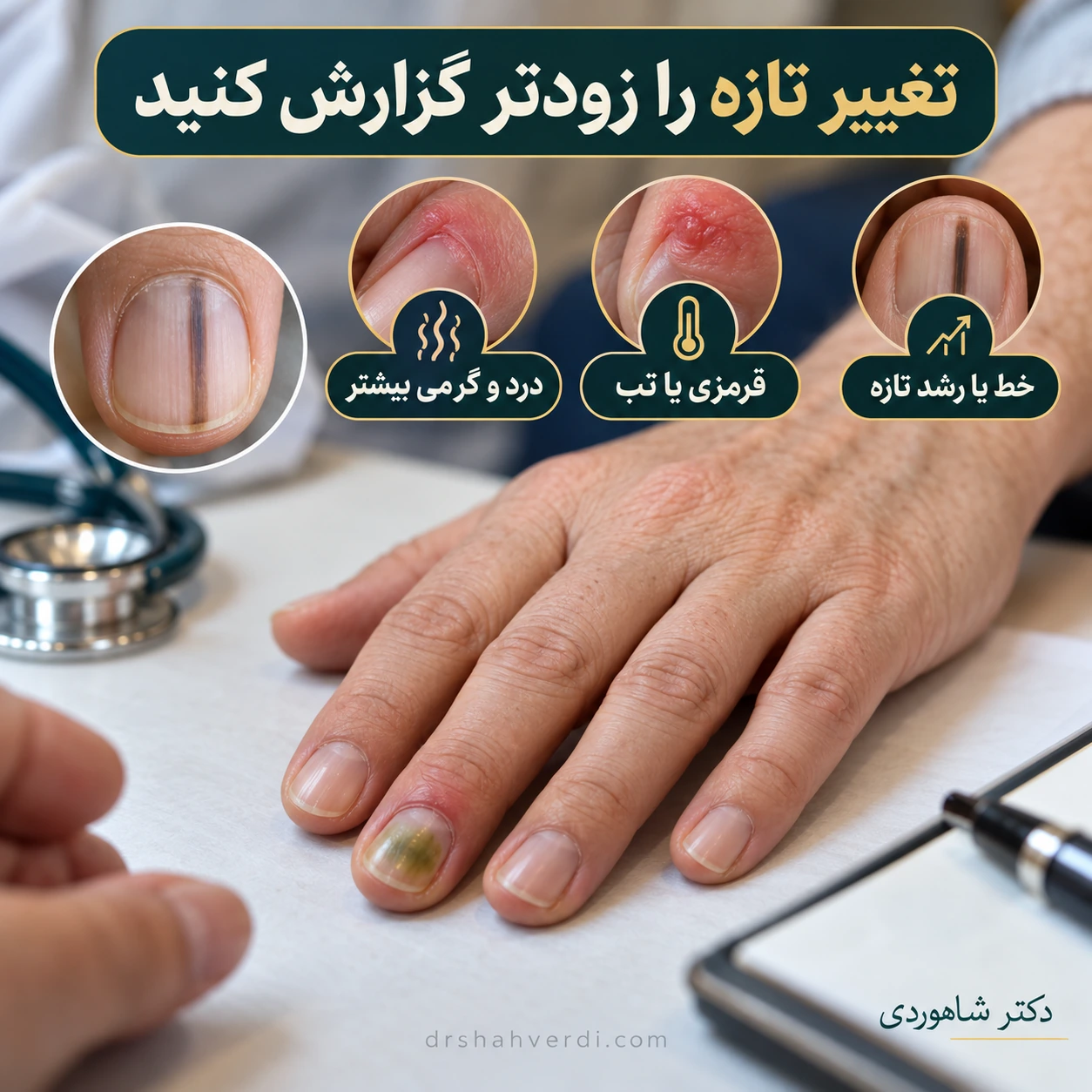بررسی پوست ملتهب پیرامون ناخن و نمونه مستقل نوار تیره تازه در ناخن