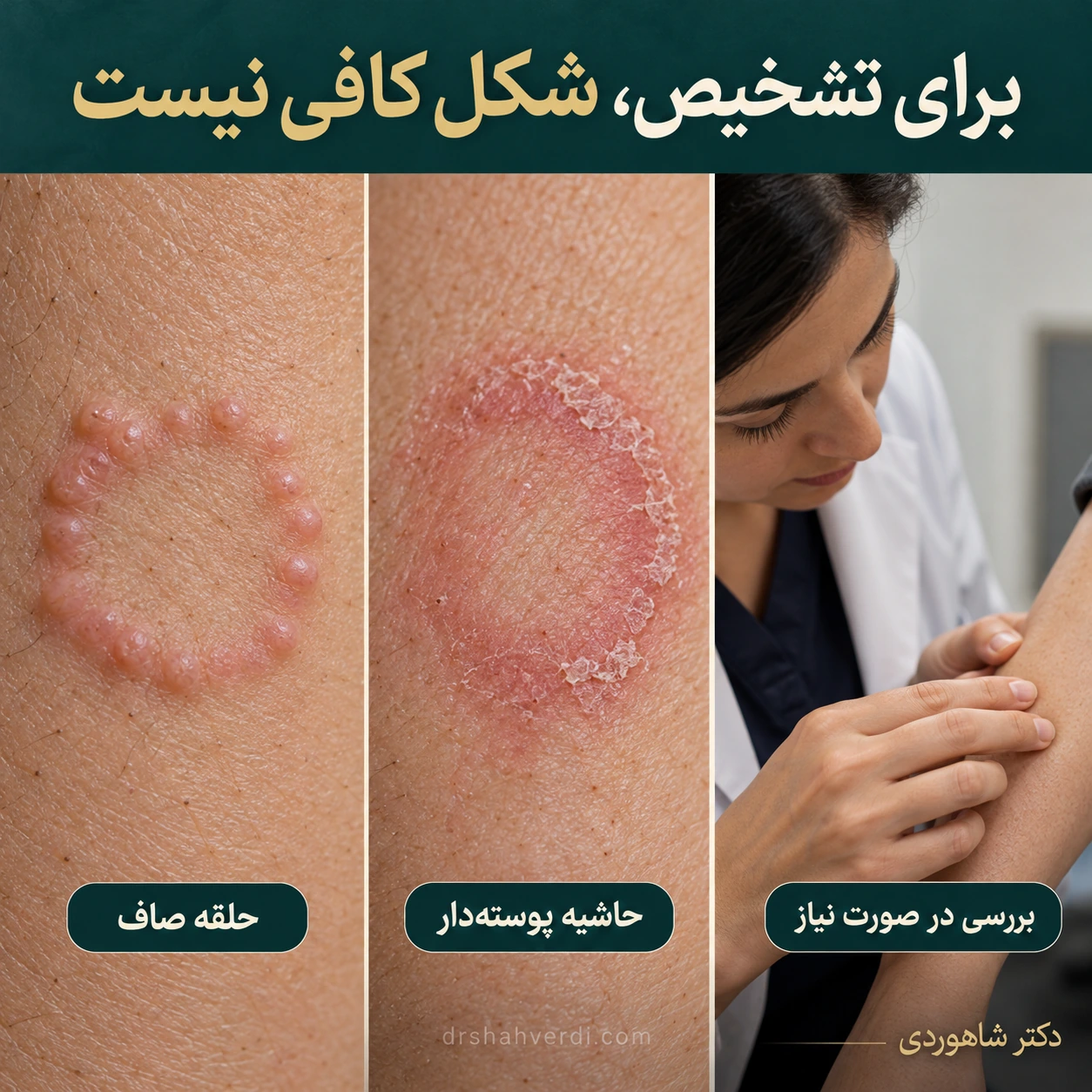 مقایسه حلقه برجستگی‌های صاف با حلقه دارای حاشیه پوسته‌دار در دو نمونه جدا