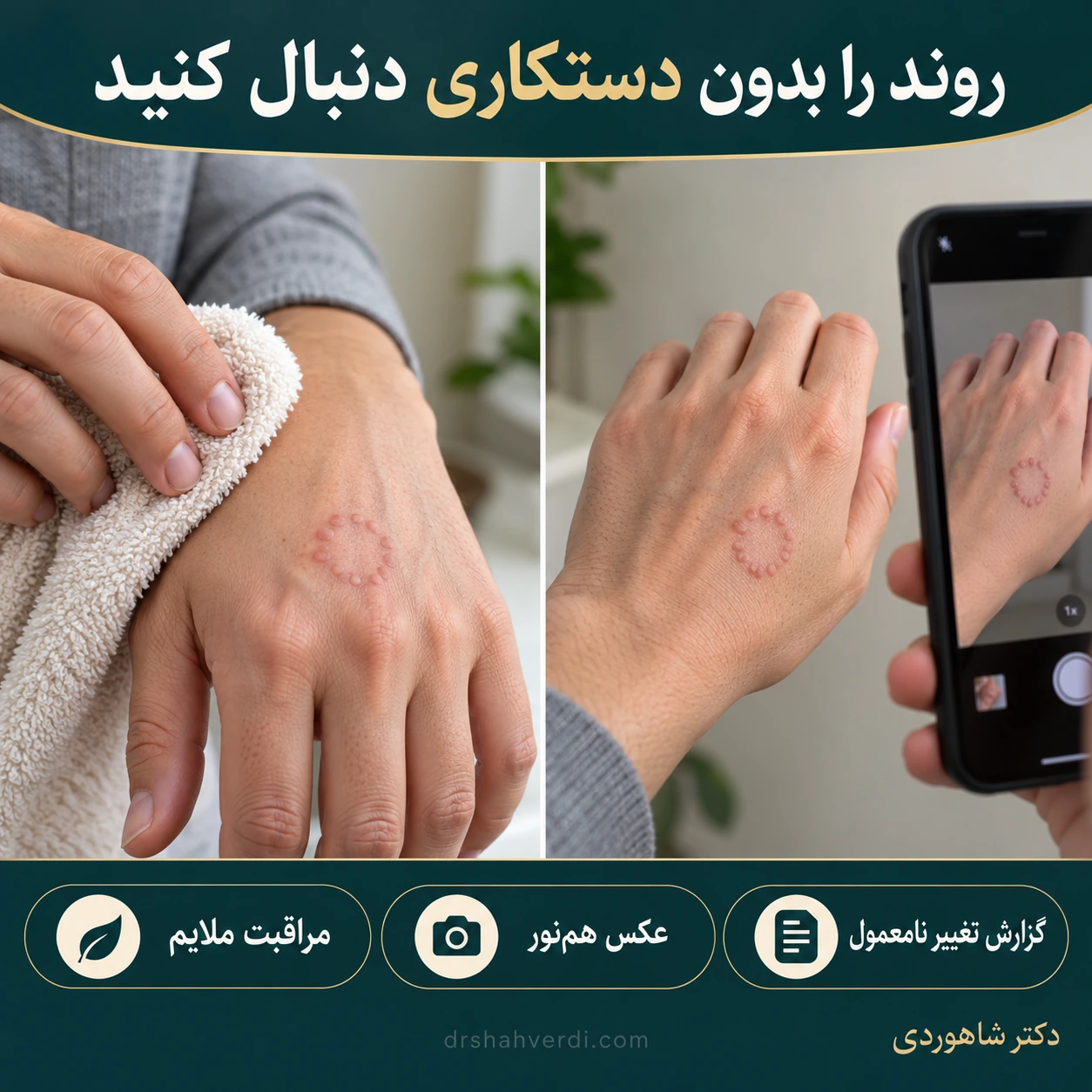 خشک‌کردن ملایم دست دارای حلقه پوستی و ثبت عکس با نور مشابه