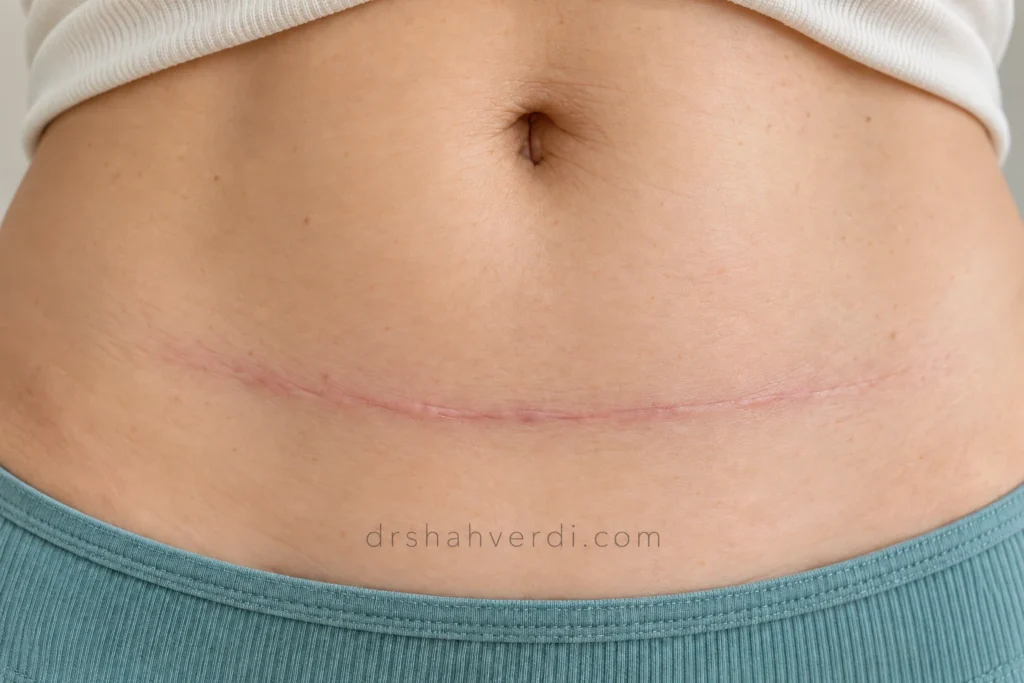 تصویر مقاله جای بخیه و اسکار سزارین؛ چه زمانی مراقبت، تزریق یا لیزر مطرح می‌شود؟