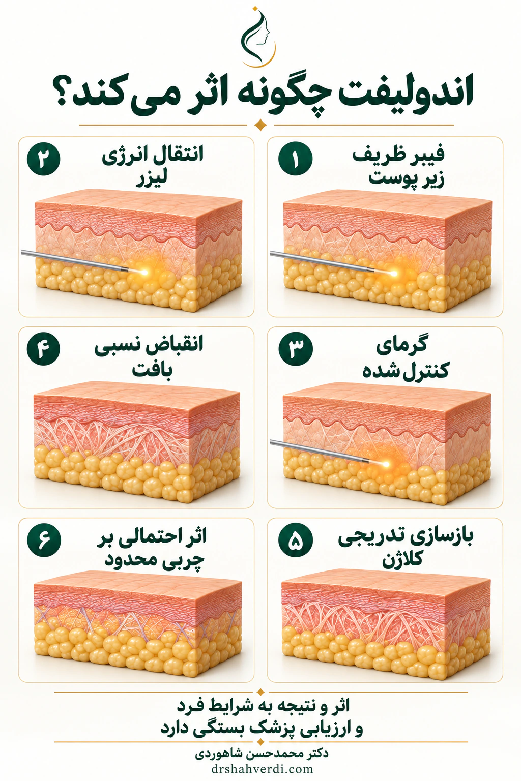 شش نمای مقطع پوست، فیبر ظریف در بافت زیرپوستی و اثرات احتمالی انرژی بر بافت