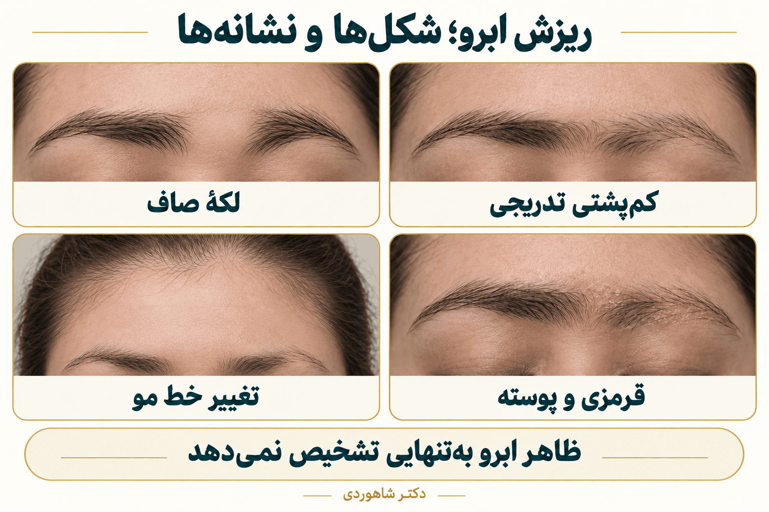 چهار طرح ریزش ابرو: کمپشتی تدریجی، لکهٔ صاف و خالی، قرمزی و پوسته، و کمپشتی همراه عقبرفتن خط مو