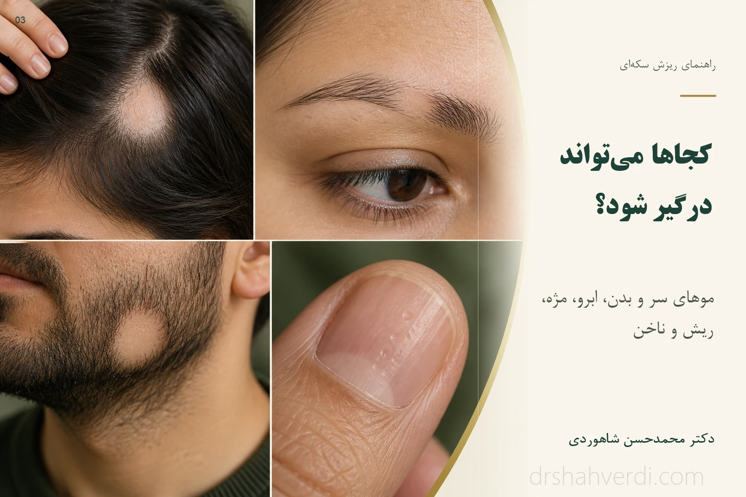 تصویر کجاها میتواند درگیر شود؟؛ موهای سر و بدن، ابرو، مژه، ریش و ناخن تصویر کجاها میتواند درگیر شود؟؛ موهای سر و بدن، ابرو، مژه، ریش و ناخن