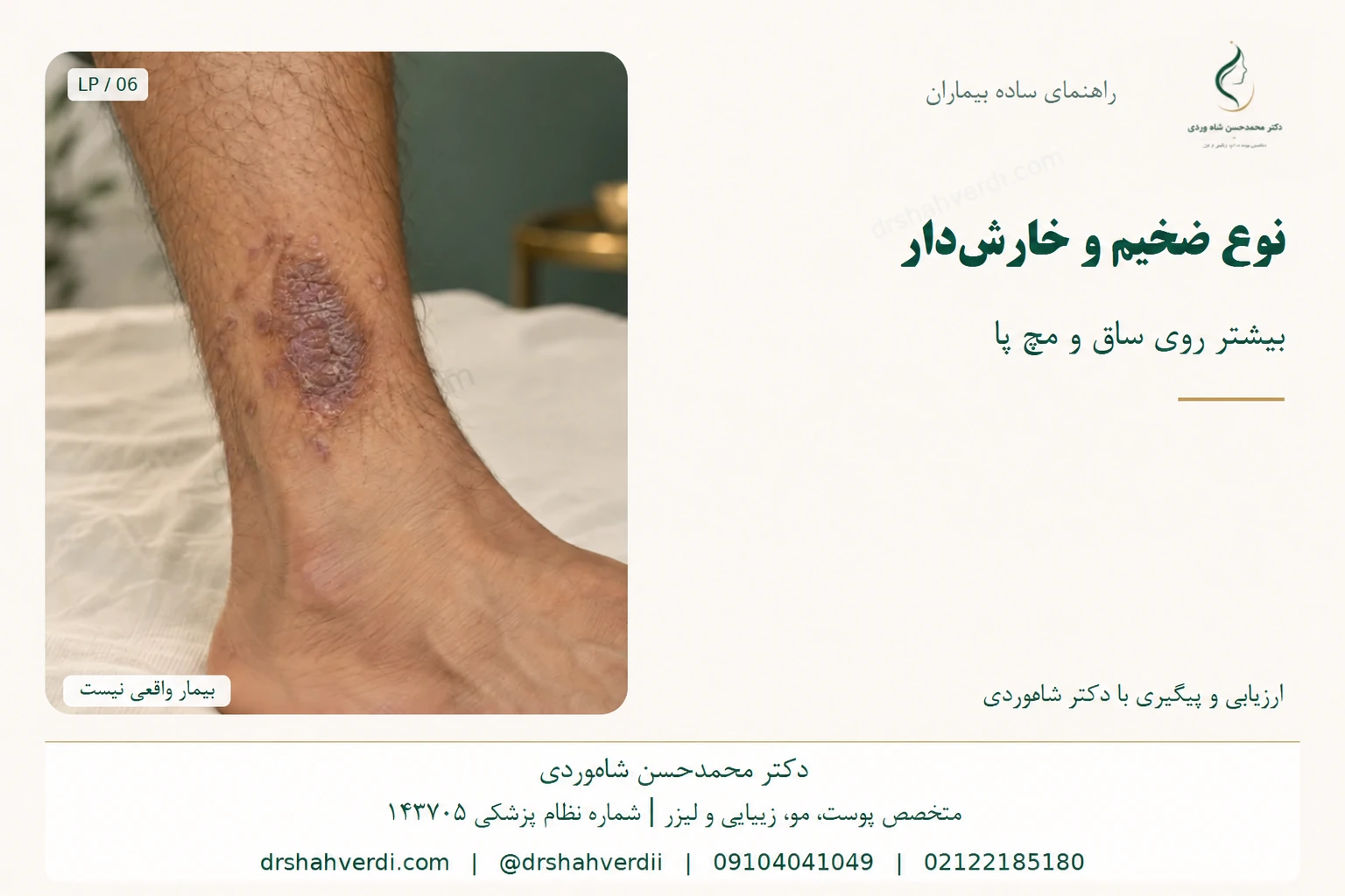 نمای ضایعه ضخیم و زبر ساق پا در لیکن پلان هیپرتروفیک
