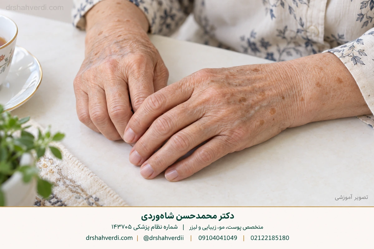 Educational view of discrete brown spots on an older hand