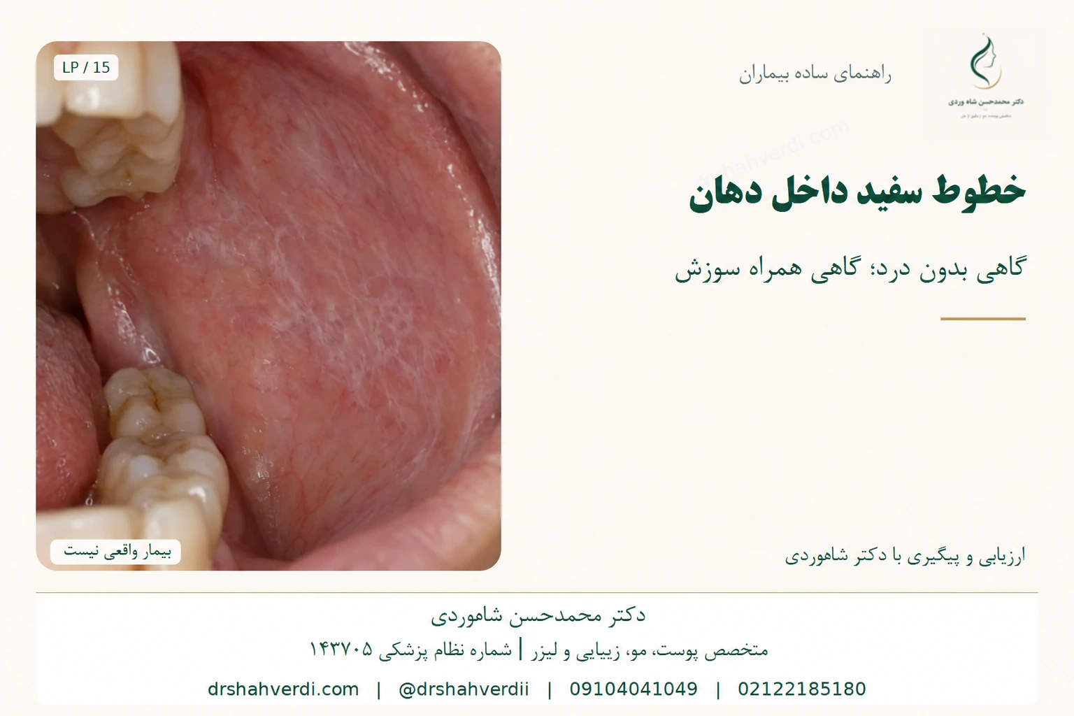 شبکه سفید ظریف در مخاط داخل گونه