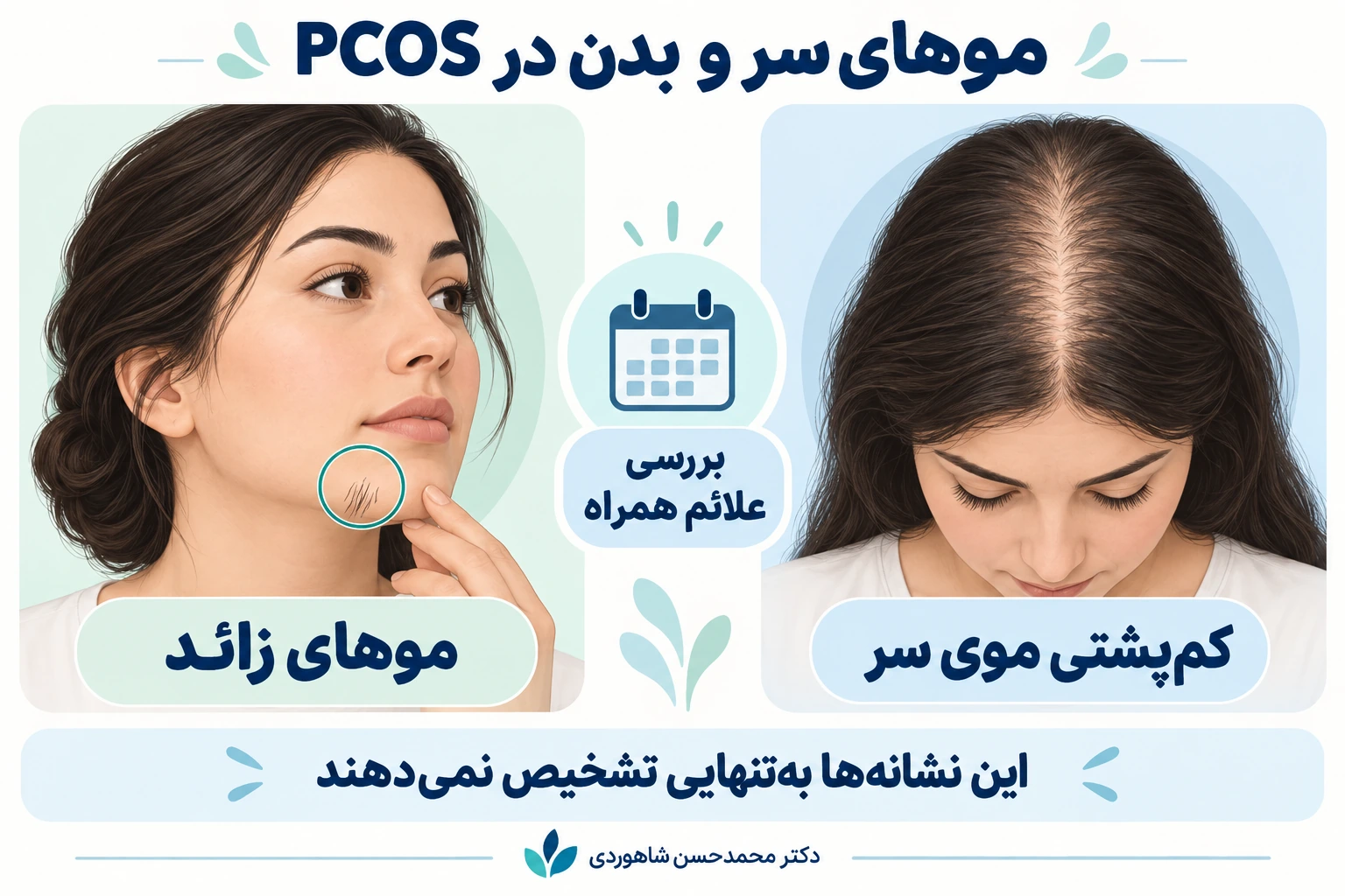 نمای آموزشی کمپشتی موی سر و موهای زائد در PCOS؛ این نشانهها بهتنهایی تشخیص نمیدهند