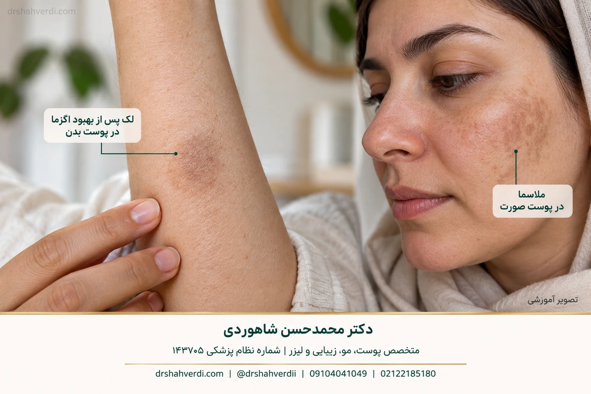 Educational example of dark marks after a skin rash