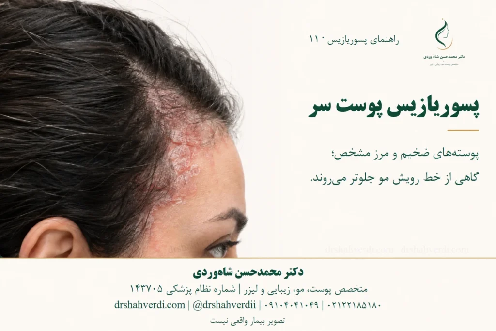 A scaly scalp plaque extending just beyond the hairline